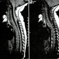 Fig.2. Caso 4: IRM que muestra la falta de coincidencia entre el quiste de inclusión y el dimple cutáneo por la migración cefálica de la médula
