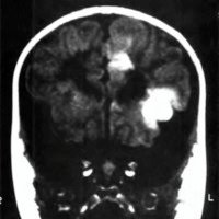 Fig. 1. Paciente de 14 meses con epilepsia médicamente intratable por tubers corticales. Se realizó lobectomía frontal izquierda.