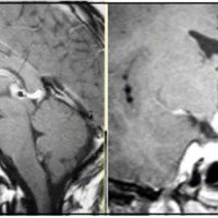 Fig. 2. IRM sagital y coronal de uno de los pacientes biopsiados por tumores hipotalámicos.