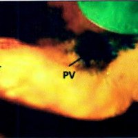 Fig. 12. Plexo venoso (PV) tipo II objetivado en la hoz del cerebro inyectada y por transiluminación en tercio posterior del SSS.