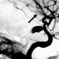 Fig. 3. Angiografia digital de la arteria carótida interna derecha en proyección lateral. Se observa aneurisma grande de cuello pequeño.