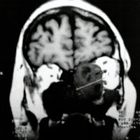 Fig. 1. IRM frontal que muestra una tumoración hipointensa.