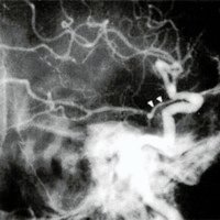 Fig. 4. Anfiografia en paciente con hematoma subdural agudo. En el perfil se observa distorsión de la arteria comunicante posterior sobre la apófisis clinoides posterior. De este vaso, nace las arterias que nutren las porciones anteriores del tálamo,