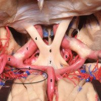 Figura 29: Visión superior de las relaciones arteriales de la fisura silviana y de las arterias lentículo-estriadas (círculo). 1) Arteria carótida interna supraclinoidea; 2) Arteria cerebral media (M1); 3) Arteria cerebral anterior (segmento A1); 4) Nervio óptico; 5) Infundíbulo hipofisario; 6) Quiasma óptico; 7) Lámina terminalis; 8) Arteria cerebral anterior (segmento A2); 9) Arteria comunicante posterior.* Arteria de Heubner.