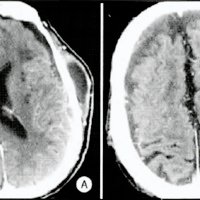 Fig. 2. TAC de cerebro: A. Colecciones extraaxiales bilaterales con ventrículos no dilatados y sin efecto de masa sobre corteza. B. Colección extraaxial con herniación a través de craniectomía.