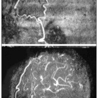 Fig. 3. Angiorresonancia 3D postoperatoria