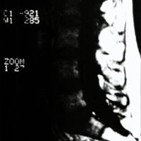 Fig. 1. Corte sagital (T1) de columna lumbosacra
