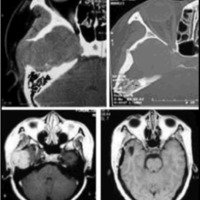 Fig. 2. TAC y IRM pre y postquirúrgicas.