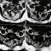 <br />
Fig. 3. Caso 3: 9 meses después de la cirugía del MMC donde se visualiza importante tumoración quística intradural que no estaba presente en el estudio anterior