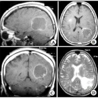 Fig. 2. IRM de cerebro corte sagital (a), axial (b), coronal (c) en T1, y axial T2 (d) donde se evidencian lesiones localizadas a nivel parietooccipital izquierda, parainsular y occipital derecha.
