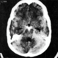 Fig. 1. TAC de cerebro sin contraste. Nótese la hemorragia a nivel de la cisterna interpeduncular y peritroncal.