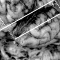 Fig. 2. Vista anterolateral de lóbulos frontal y temporal izquierdo. A-A´: línea fronto-rolándica. B-B´: línea temporo-rolándica.