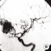 Fig 1.Malformación arteriovenosa frontooccipital. A. TAC preoperatoria. B. Angiografía preoperatoria. C. Angiografia postoperatoria