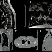 Tumor dumbbel preoperatorio: A y B: RMI T2 muestran exéresis completa de lesión T3 en reloj de arena. C: TAC coronal expansión del ápice pulmonar izquierdo. D y E: Muestran disminución de remodelación ósea a nivel del cuerpo T3 y ausencia de deformidad postoperatoria.