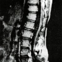 Fig. 3. IRM que muestra médula amarrada secundaria a