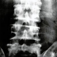 Fig. 4. Radiografía postquirúrgica. Resección parcial articular L5-S1 izquierda.