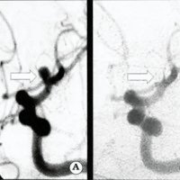 Fig. 2. Angiografía carotídea izquierda en incidencia oblicua-anterior que muestra, A. Pequeño aneurisma en la bifurcación carotídea (flecha). B. Control a tres meses postemblización donde se observa exclusión aneurismática (flecha).