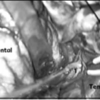 Fig. 6. Abierto el valle silviano, se sigue la arteria silviana y se encuentra precozmente la arteria terminal principal (1), vista en la angiografía. La misma fue coagulada.