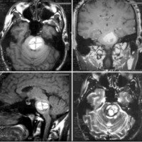 Cavernomas del tronco encefálico: presentación de dos casos y revisión bibliográfica