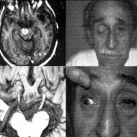 Fig. 1. Parálisis del NMOC por metástasis a nivel de pedúnculo cerebral.