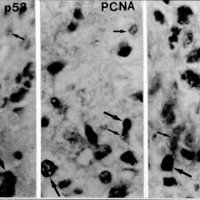 Fig. 4. Reactividad de la inmunomarcación para p53, PCNA y EGFR (flechas)