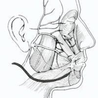 Fig. 7. Técnica de Sawamura. El nervio facial drilado en el hueso temporal es unido mediante neurorrafia término-lateral con el hipogloso.