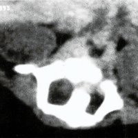 Fig. 3. Diastematomielia. Corte tomográfico en el cual se aprecia la presencia de cartílago en el extremo anterior del tabique.