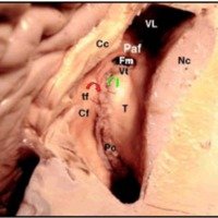Fig. 6. A. Corte axial a nivel del ventrículo lateral derecho donde se visualiza Pc: plexo coroideo; Cf: columna del fórnix; Paf: pilar anterior del fórnix; Vt: vena talamoestriada; T: tálamo; Cc: cuerpo calloso; Fm: foramen de Monro; Nc: núcleo caudado; VL: ventrículo lateral; Tc: tenia coroidea; Tf: tenia fornicis. Se observa la vía de abordaje subcoroidal (a través de la tenia coroideaflecha verde-) y la transcoroidal (a través de la tenia fornicisflecha roja-)