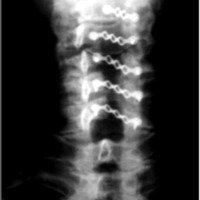 Fig. 3. Radiografía simple cervical de frente que muestra la ubicación de las miniplacas y la apertura ósea.