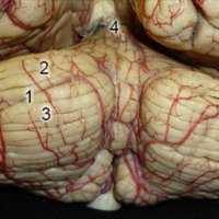 Figura 2: Vista general de la cara suboccipital del cerebelo. Obsérvese la fácil identificación de la fisura horizontal. 1) Fisura horizontal. 2) Lobulillo semilunar superior. 3) Lobulillo semilunar inferior. 4) Culmen. 5) Amígdala cerebelosa.