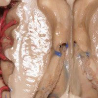 Figura 12: Visión superior de la relación entre el córtex insular y la arteria cerebral media con los ganglios de la base y ventrículo lateral. Podemos observar la correspondencia entre el segundo giro corto de la ínsula (1) y el foramen de Monro (2).