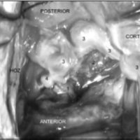 Fig. 8. Imagen intraoperatoria, para correlacionar con angiografía. 1: arteria terminal principal; 2: nido; 3: vena de drenaje principal; 4: seudoaneurisma intranidal<br />
