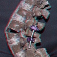 Figura 8: Vista lateral izquierda. Osteotomía de grado 4. La resección incluye una cuña de cuerpo vertebral de L4 y el disco y platillo vertebral de L3. Luego del cierre de la osteotomía se aprecia la magnitud de la corrección obtenida.