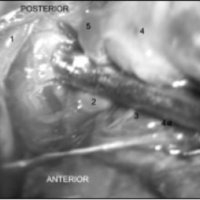 Fig. 9. La disección más profunda revela la pericallosa pasante (1), con la arteria terminal principal (2), el nido (4a), la vena de drenaje (4) y el seudoaneurisma venoso (5). Se observa una arteriola de shunteo (3).<br />
