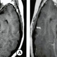 Fig. 3. Paciente sexo femenino 31 años de edad. A. RM corte axial T1 con contraste mostrando lesión mesencefalo-pontina izq. B. RM corte axial T1 postoperatorio sin lesión residual.