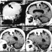 Fig. 3. Angiorresonancia objetivándose la interrupción del flujo a nivel del SSS (Flecha gruesa) e IRM de cerebro con contraste donde se evidencia una lesión sagital (flechas) que compromete al seno sagital superior.<br />
