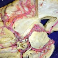 Figura 28: Vista inferior. 1) Arteria cerebral media (segmento M1) con ramos perforante (arteria lentículo-estriadas); 2) Limen de la  ínsula; 3) Arteria cerebral media (segmento M2); 4) Arteria cerebral posterior; 5) Arteria calcarina 6) Nervio oculomotor; 7) Glándula pituitaria; 8) Quiasma Óptico; 9) Arteria carótida interna; 10) Uncus; 11) Giro dentado.