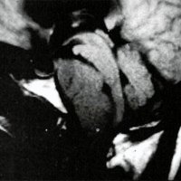 Fig. 4. RNM, meningioma del clivus