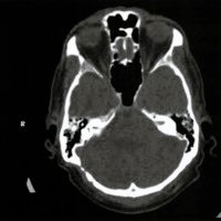 Fig. 2. Paciente sexo masculino de 67 años de edad. Corte axial de tomografta computada (ventana ósea) a los 63 meses de postoperatorio evidenciando reosificación del defecto óseo derecho.