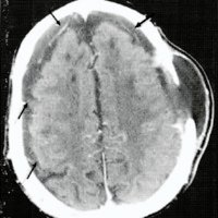 Fig. 3. TAC de cerebro con contraste. Venas corticales (flechas) extendiéndose a través de colecciones extraxiales ("signo de vena cortical").