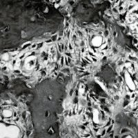 Fig 3. Preparado histolopatológico. Se observa tejido osteoide y hueso inmaduro rodeados de osteoblastos, células gigantes dentro de un estroma fibroso hipervascularizado.
