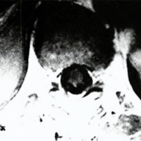 Fig. 2. IRM pretratamiento: corte axial correspondiente a lafistula D8 izquierda que muestra el sufrimiento isquémico centromedular por hipertensión venosa.