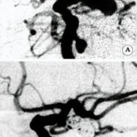 Fig. 8. A. Angiografia digital de la arteria carótida interna izquierda en proyección oblicua anterior derecha donde muestra un aneurisma grande de cuello pequeño que se origina de la ACoP propiamente dicha. B. Control postembolización que muestra una oclusión D.