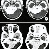 Fig. 3. A. Preoperative T1-weighted MRI scans showing a retrocerebellar arachnoid cyst. B. Postoperative showing a reduction in the cyst volume and some expansion of the cerebellar hemispheres.
