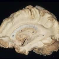 Figura 17: Visión de la cara lateral del hemisferio cerebral derecho a través de la disección de fibras blancas por la técnica de Klinger. 1) Núcleo caudado; 2) Cuerno frontal del ventrículo lateral; 3) Cápsula interna (brazo anterior); 4) Comisura anterior; 5) Alza de Meyer; 6) Tálamo; 7) Radiación óptica.