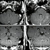 Fig. 7. Imagen de resonancia magnética postoperatoria. A y B. Cortes axiales. C y D. Cortes coronales en secuencia Ti con contraste. Se observa reducción del quiste y de su contenido hiperintenso, y aire dentro de la cavidad residual. Reducción de la compresión del cerebelo y del lóbulo temporal.