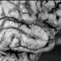 Fig.1. Vista anterolateral del neocórtex del lóbulo temporal derecho. T1: primera circunvolución temporal. T2: segunda circunvolución temporal. T3: tercera circunvolución temporal.