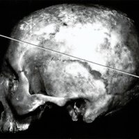 Fig. 3. Vista lateral de un cráneo, donde se observa la línea de de scalotamiento (va desde la glabela a un punto que se encuentra 3 cm por arriba del inion).