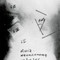Figura 2. Muestra cifosis lumbar secundaria a laminectomía.