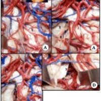 Fig. 20. Pasos en la amigdalohipocampectomía selectiva. A. La línea de puntos nos indica la incisión lateral al surco inferior de la ínsula. B. Una vez alcanzado el ventrículo , identificamos el hipocampo, el plexo coroideo y la fisura coroidea. C. Para ver mejor la fisura se ha resecado el plexo coroideo dejando ver parte de la cisterna ambiens. D. la resección del hipocampo deja ver el mesencéfalo y resecamos el hipocampo. 1. ínsula. 2 polo temporal. 3 hipocampo. 4 plexo coroideo.5 fisura coroidea. 6 cisterna ambiens. 7 tentorio. 8 tronco cerebral.